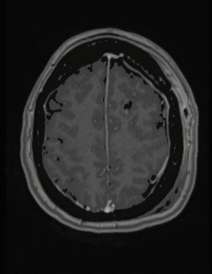 Astrozytom Astrozytom