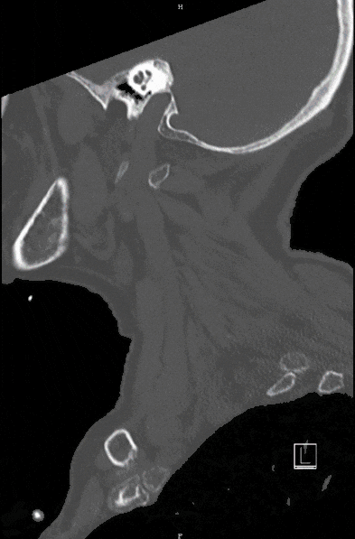 Densfraktur_Wirbelsaeulenverletzungen Densfraktur_Wirbelsaeulenverletzungen